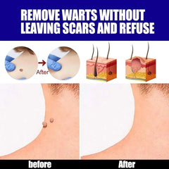 Warts Remover